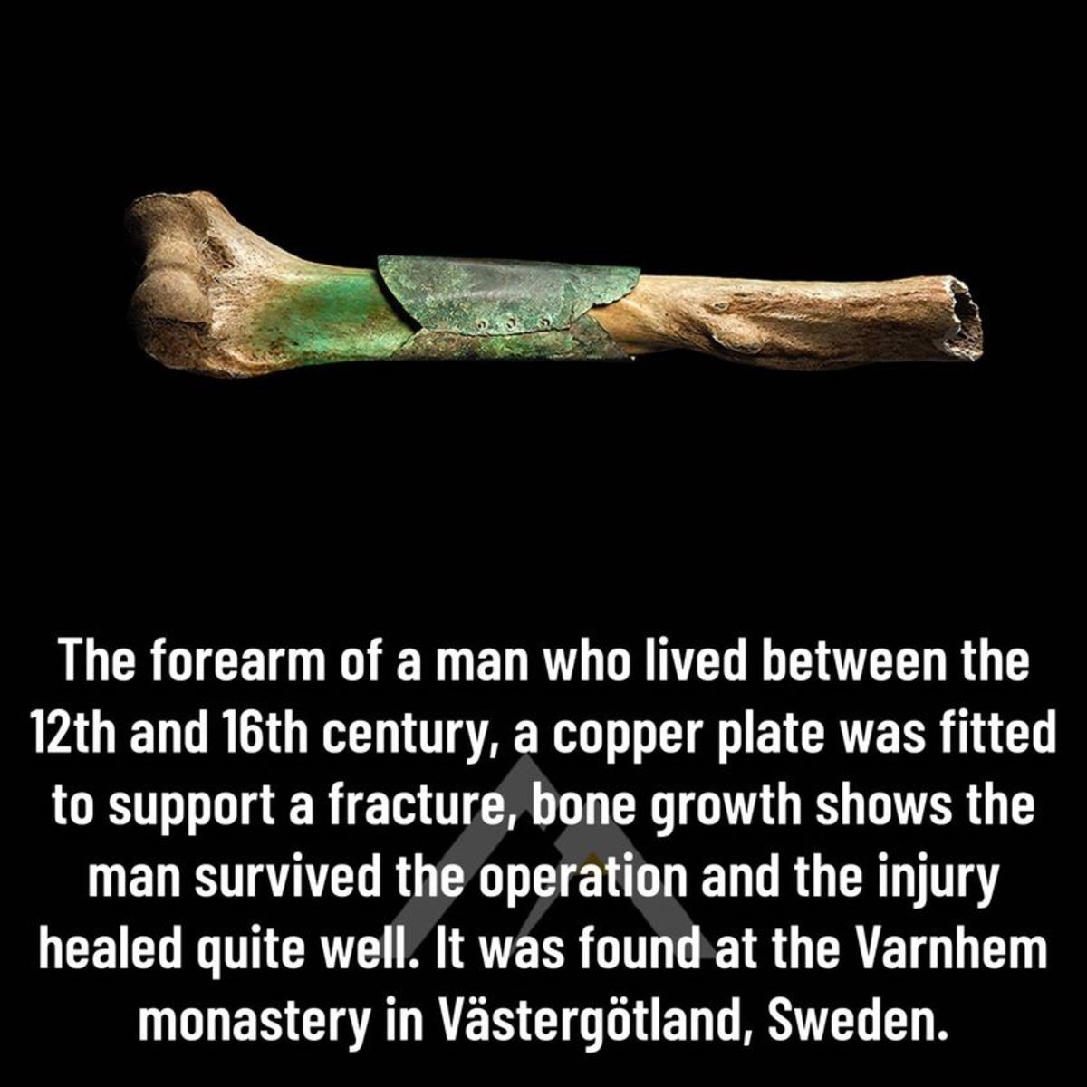 foolhardy Nutjobs. .. Can you imagine the amount of pain having that bone exposed, set, copper plates hammered around it and the flesh stitched back. All with probably nothing more t