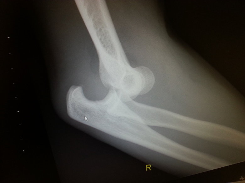 My dislocated arm x-ray.. .. Holy , that top bone looks like a !