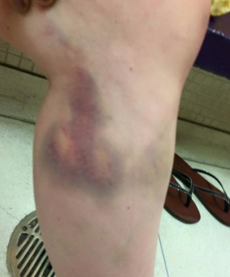 Weird Bruise. .. That's what happens when the hammer gets loose