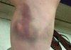 Weird Bruise