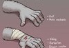 Hand scars